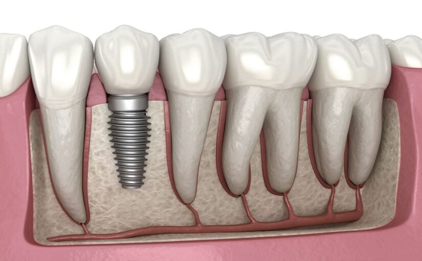 The Best Dental Implant Clinic in Dubai￼
